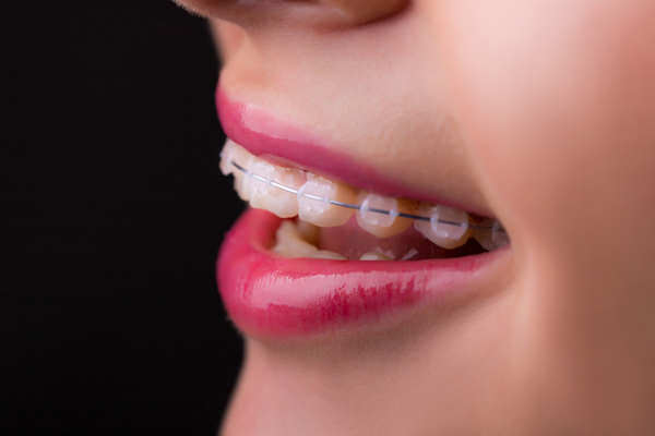 Why Should I Consider Clear Braces?