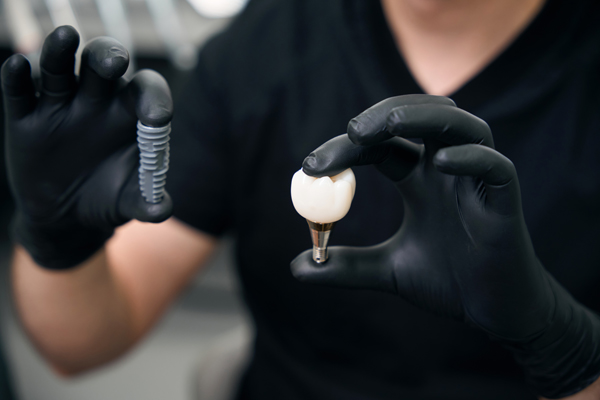 Missing A Single Tooth? Consider A Dental Implant
