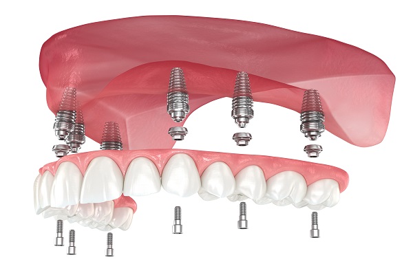 Implant Supported Dentures Flower Mound, TX