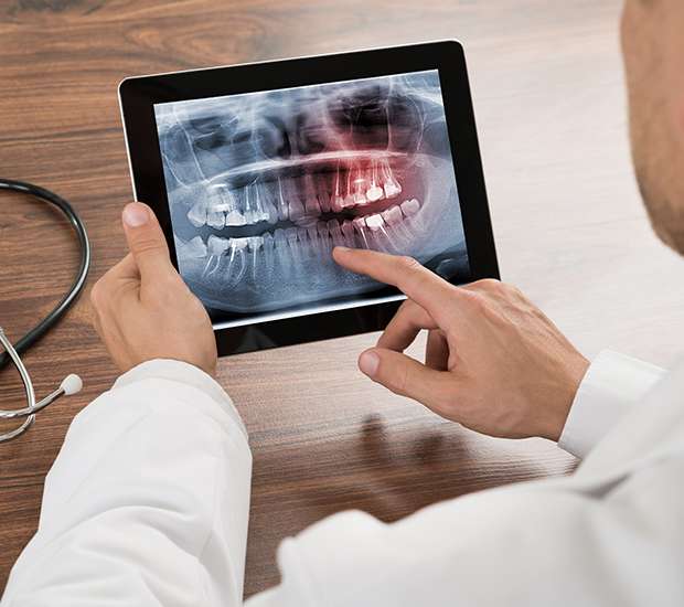 Flower Mound Types of Dental Root Fractures